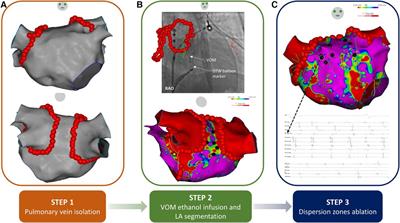 A novel stepwise approach incorporating ethanol infusion in the vein of Marshall for the ablation of persistent atrial fibrillation